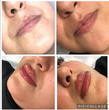 Lip Treatments