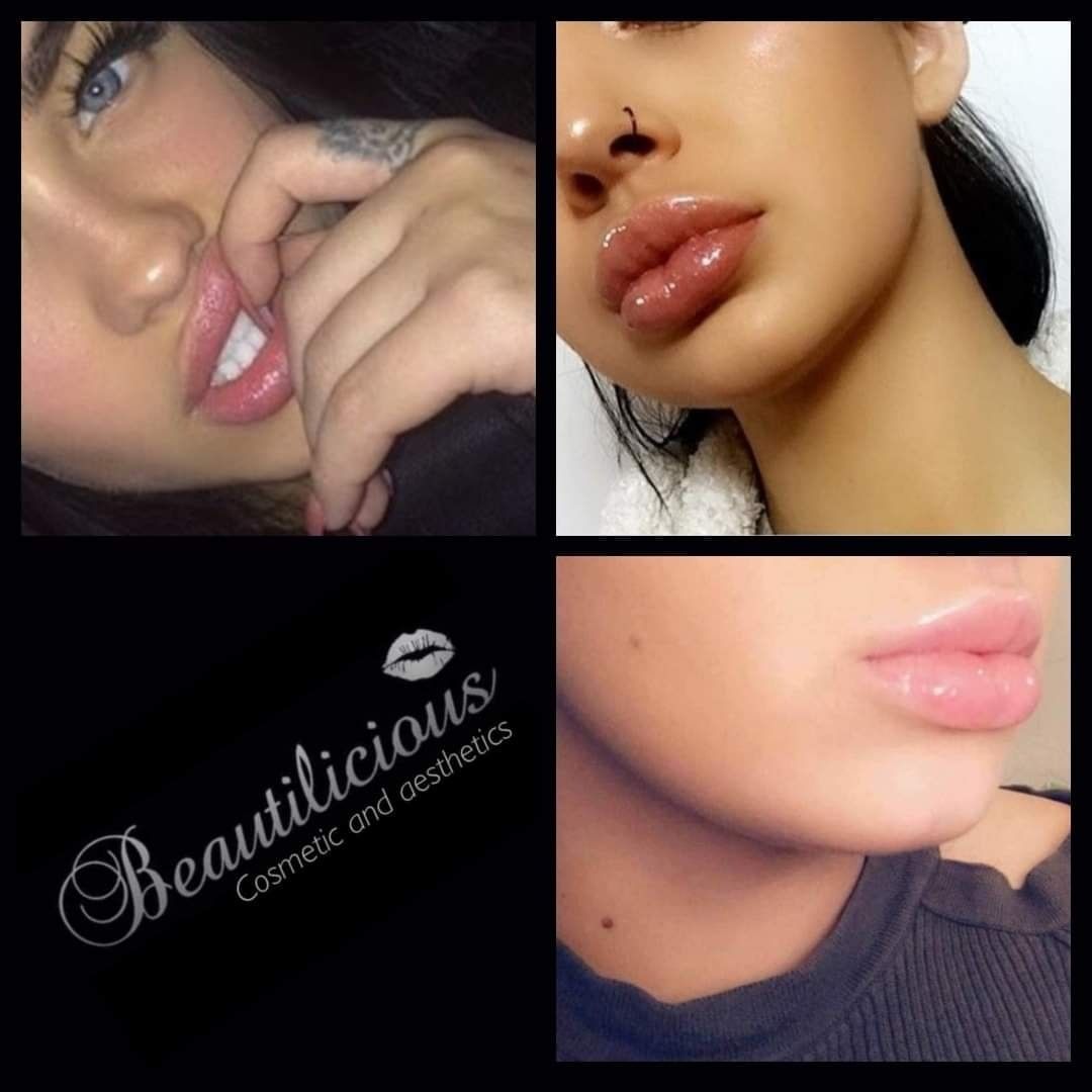 Lip Filler Treatments