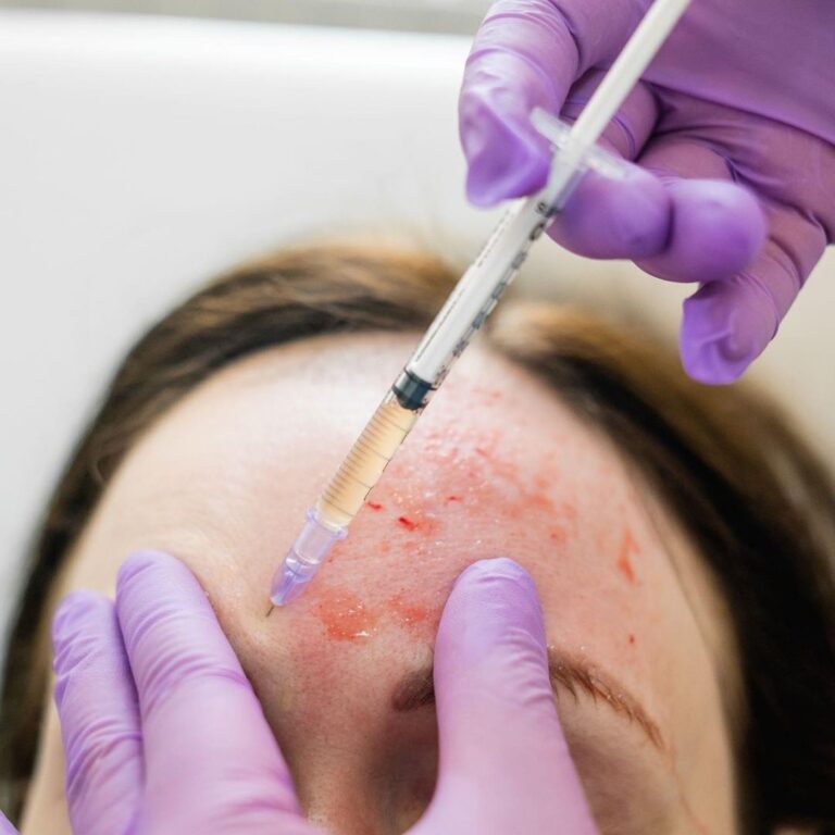 Anti Wrinkle and Dermal Filler Treatments